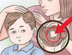 Image result for Child Hair Loss