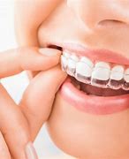 Image result for Invisalign Teeth Braces