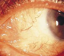 Image result for Conjunctival Granuloma Eye