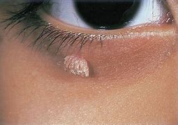 Image result for Wart On Inside of Eyelid