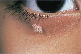 Image result for Wart On Eyelid