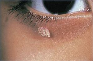 Image result for Warts On Eyelids Pictures