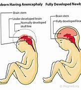 Image result for Anencephaly Syndrome