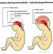 Image result for Fetal Death Anencephaly