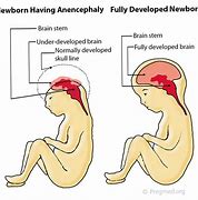 Image result for Anencephaly Drawing