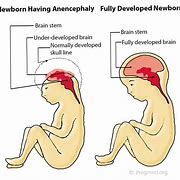 Image result for Anencephaly Fetal Doppler