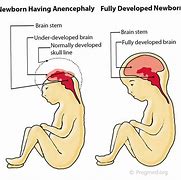 Image result for Anencephaly CT