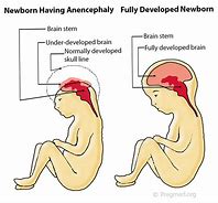 Image result for Anencephaly