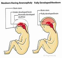 Image result for Anencephaly Fetal Ultrasound