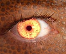 Image result for Red Eye Astigmatism