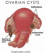 Image result for Ovarian Cyst Rupture Symptoms