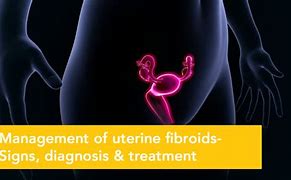 Image result for Uterine Fibroid Degeneration