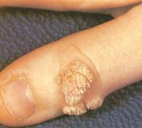 Image result for Infected Wart