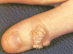 Image result for Verruca Lesion