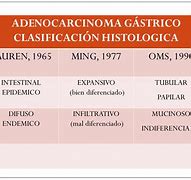 Image result for Quais OS Sintomas Cancer Gastrico