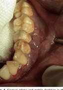 Image result for Alveolar Osteitis