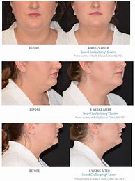 Image result for CoolSculpting Double Chin Before and After