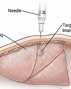 Image result for Needle Biopsy Lung Nodule