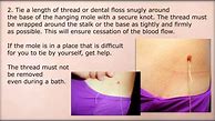 Image result for Skin Tags On Neck