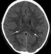 Image result for Choroid Plexus CT