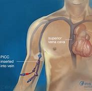 Image result for Central PICC Line