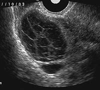 Image result for Ovarian Cyst with Septation