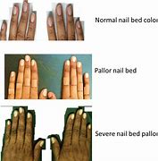 Image result for Pallor Color