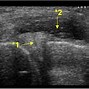 Image result for Meniscal Cyst Ultrasound