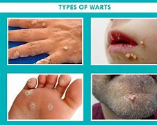 Image result for Viral Warts On Hands