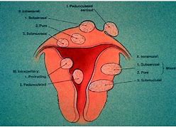 Image result for 6 Cm Uterine Fibroid