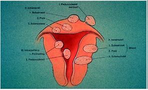 Image result for 16Cm Cyst