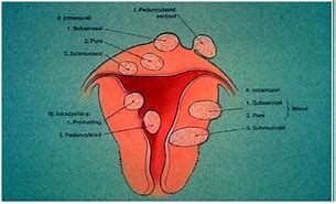 Image result for 13 Cm Fibroid