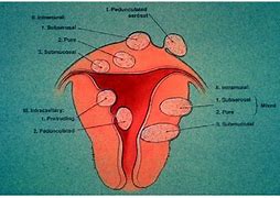 Image result for Anterior Uterine Fibroid