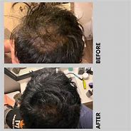 Image result for Topical Dutasteride Before and After