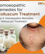 Image result for Molluscum Homeopathic