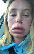 Image result for Swollen Lips Allergic Reaction