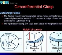 Image result for Circumferential Clasp