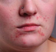 Image result for Skin Lesions On Face