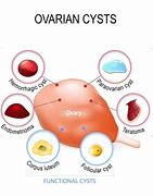 Image result for 5 Cm Cyst On Ovary