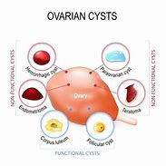 Image result for Complex Cyst On Ovary