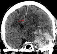 Image result for Falcine Sdh On CT Scan