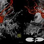 Image result for internal carotid arteries anatomy