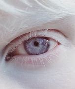 Image result for Albino Human Eye Color