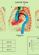 Image result for Thoracic Aorta Branches