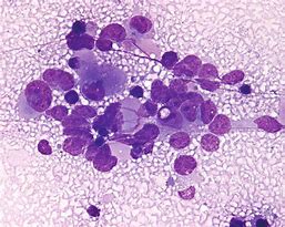 Image result for Round Cell Sarcoma