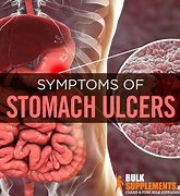 Image result for Intestine Ulcer