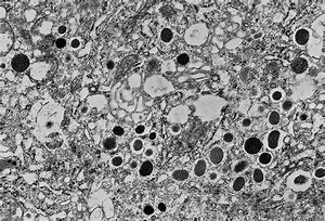 Image result for Carcinoid Tumor Electron Microscopy