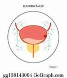 Image result for Bladder Cancer Tumor Size