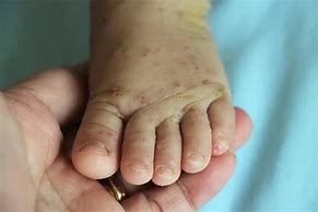 Image result for Scabies Baby