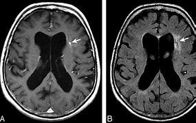 Image result for Brain Abnormalities